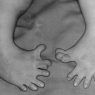 Congenital malformation of the feet. Effects of maternal drugs - thalidomide. Photo courtesy of