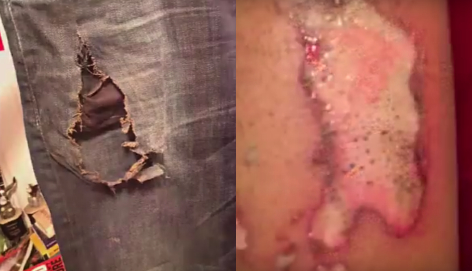 Bradley says the exploding iPhone charger left this hole in his jeans (left) and this wound on his leg (right).
