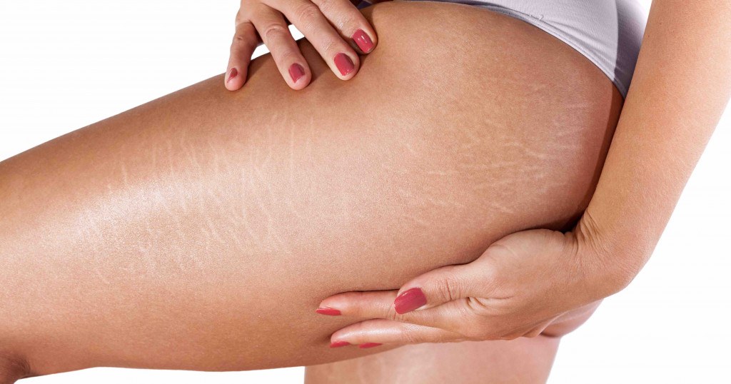bathing suits that cover stretch marks on thighs