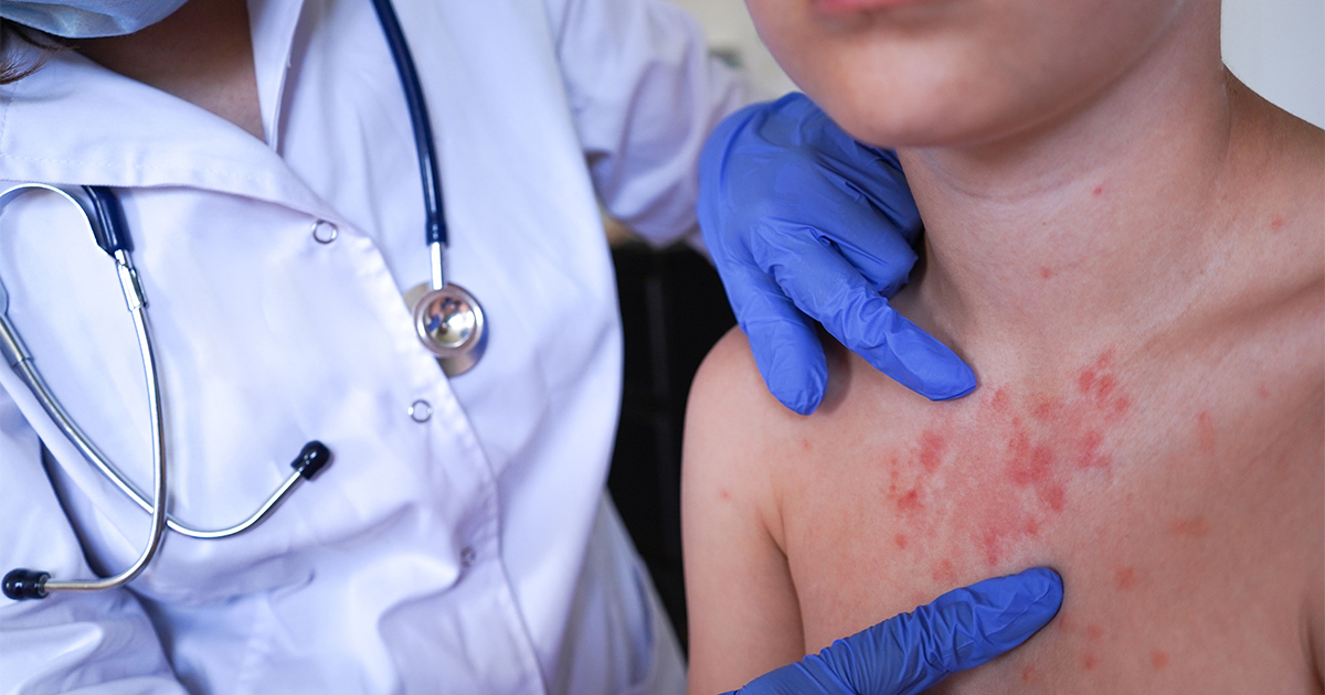 Could Philly See Another Measles Outbreak?