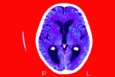 brain scan with a person with dementia caused by Alzheimer's disease