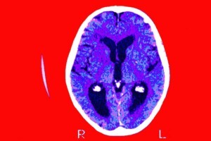 brain scan with a person with dementia caused by Alzheimer's disease
